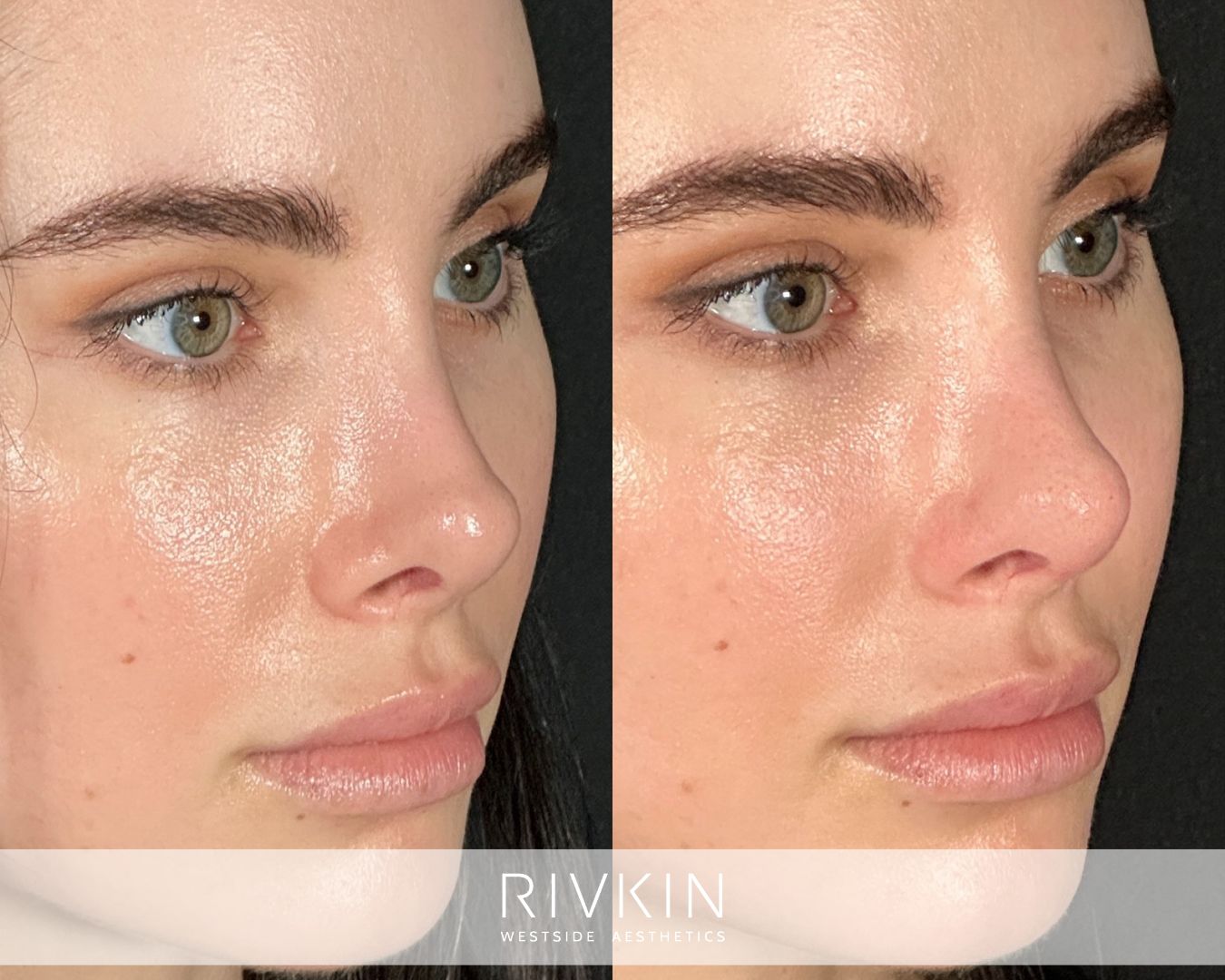 before and after surgical rhinoplasty