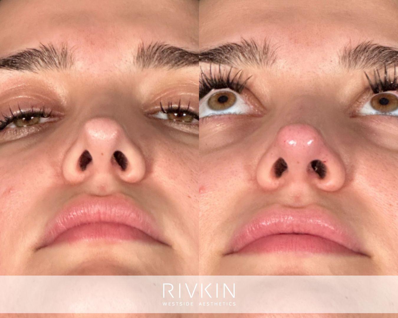 patient before and after surgical rhinoplasty