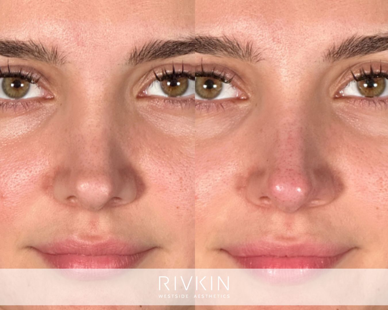 patient before and after surgical rhinoplasty