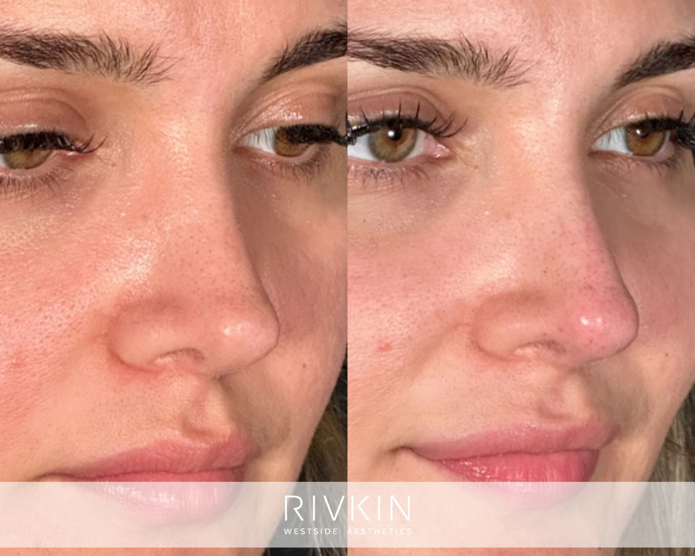 patient before and after surgical rhinoplasty