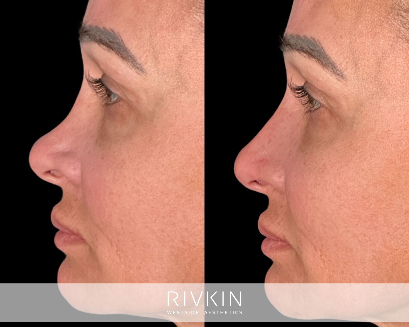 Before non-surgical revision rhinoplasty