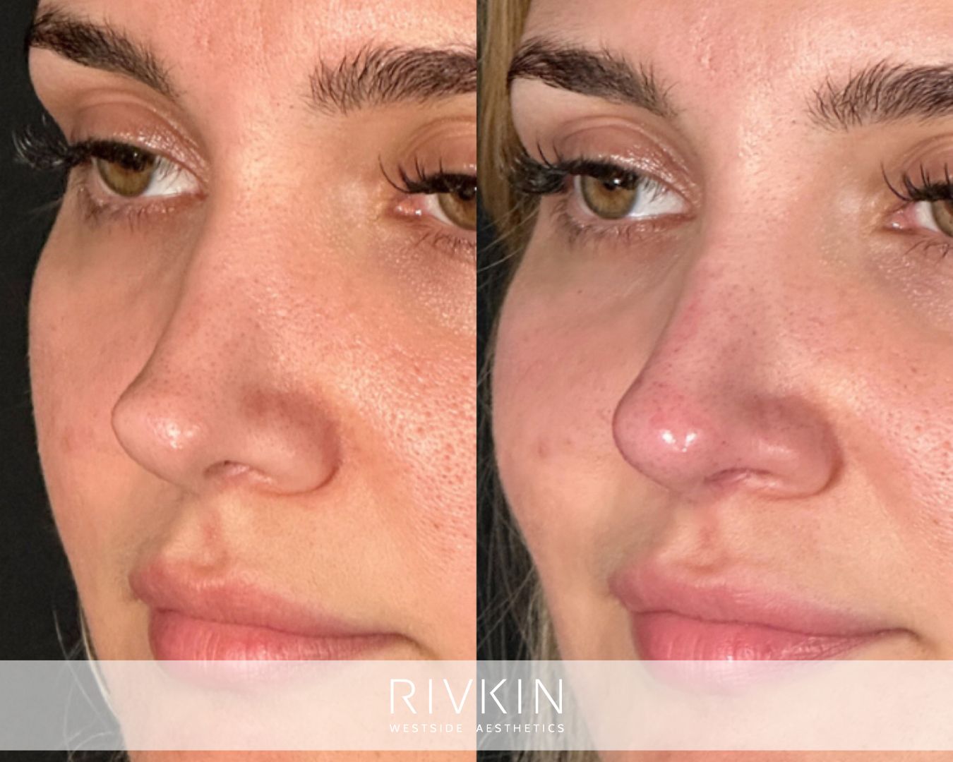 patient before and after surgical rhinoplasty