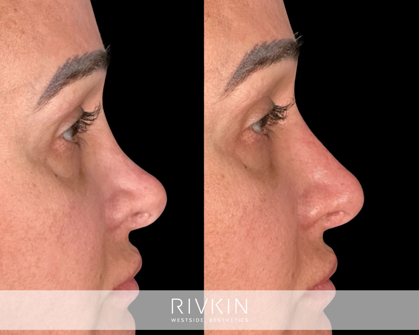 Before non-surgical revision rhinoplasty