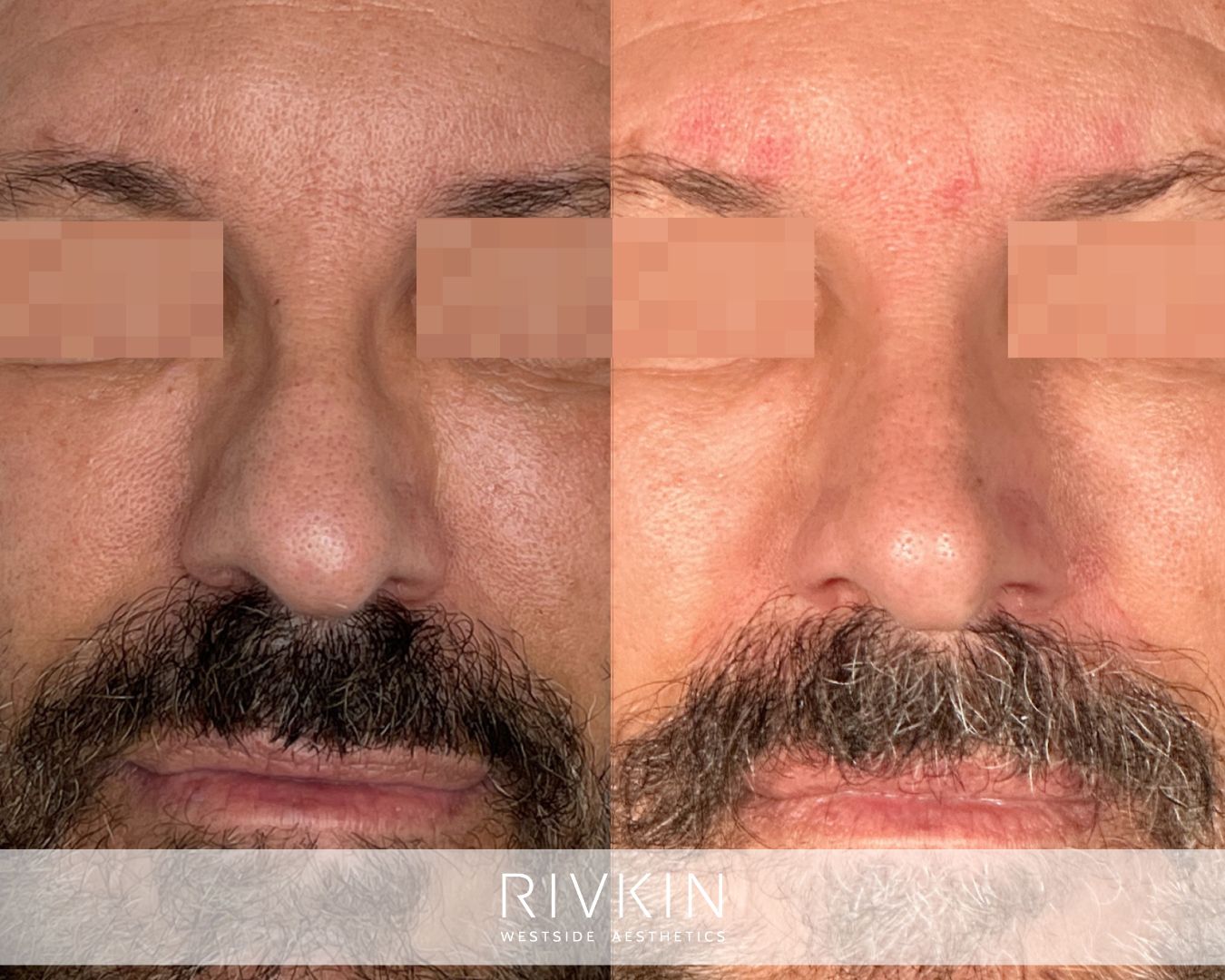 Non-surgical nose tip correction