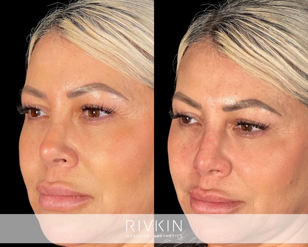 Revision Rhinoplasty