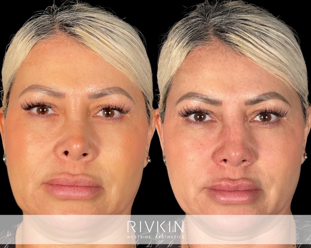 Revision Rhinoplasty