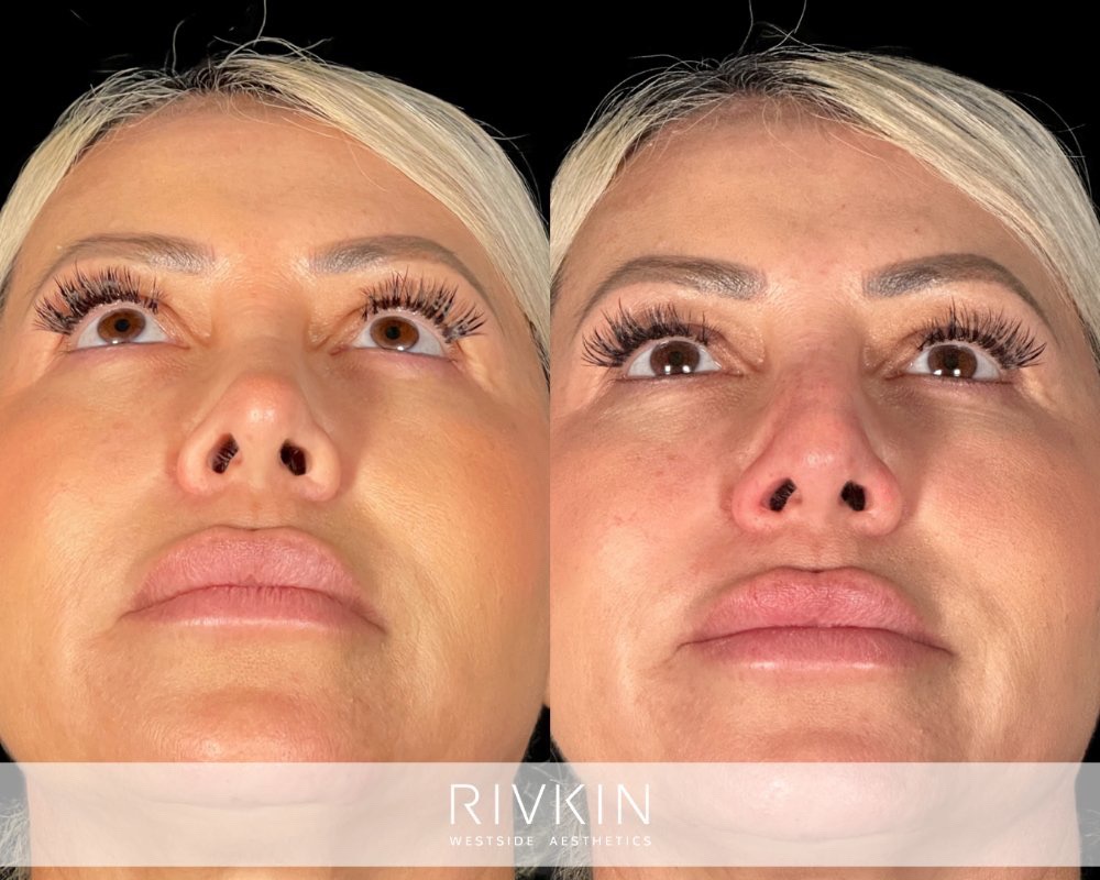 Revision Rhinoplasty