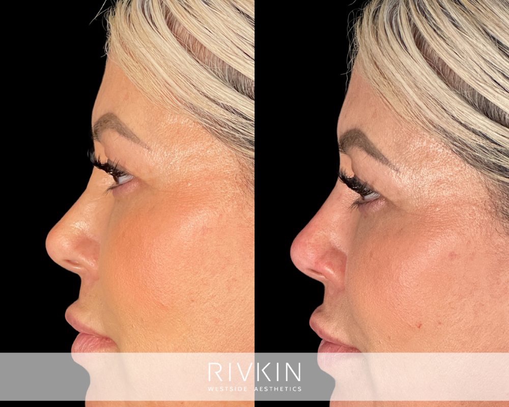 Revision Rhinoplasty