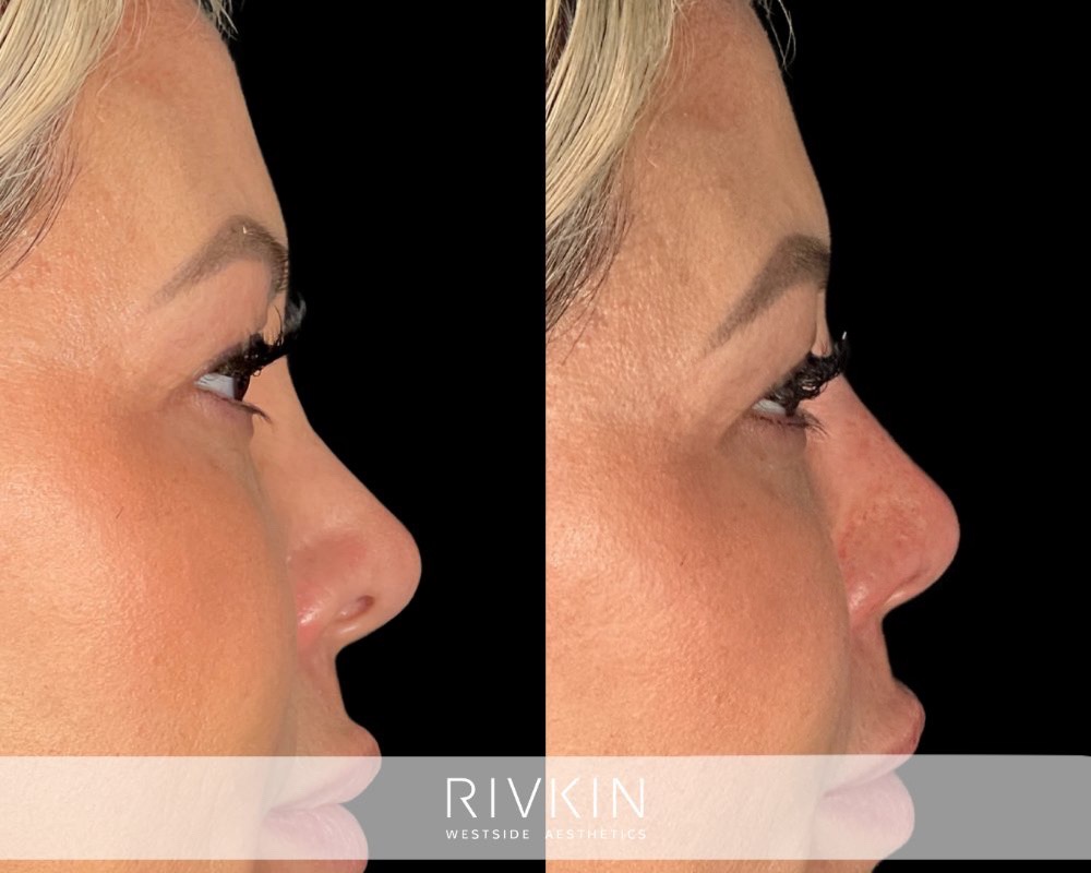 Revision Rhinoplasty