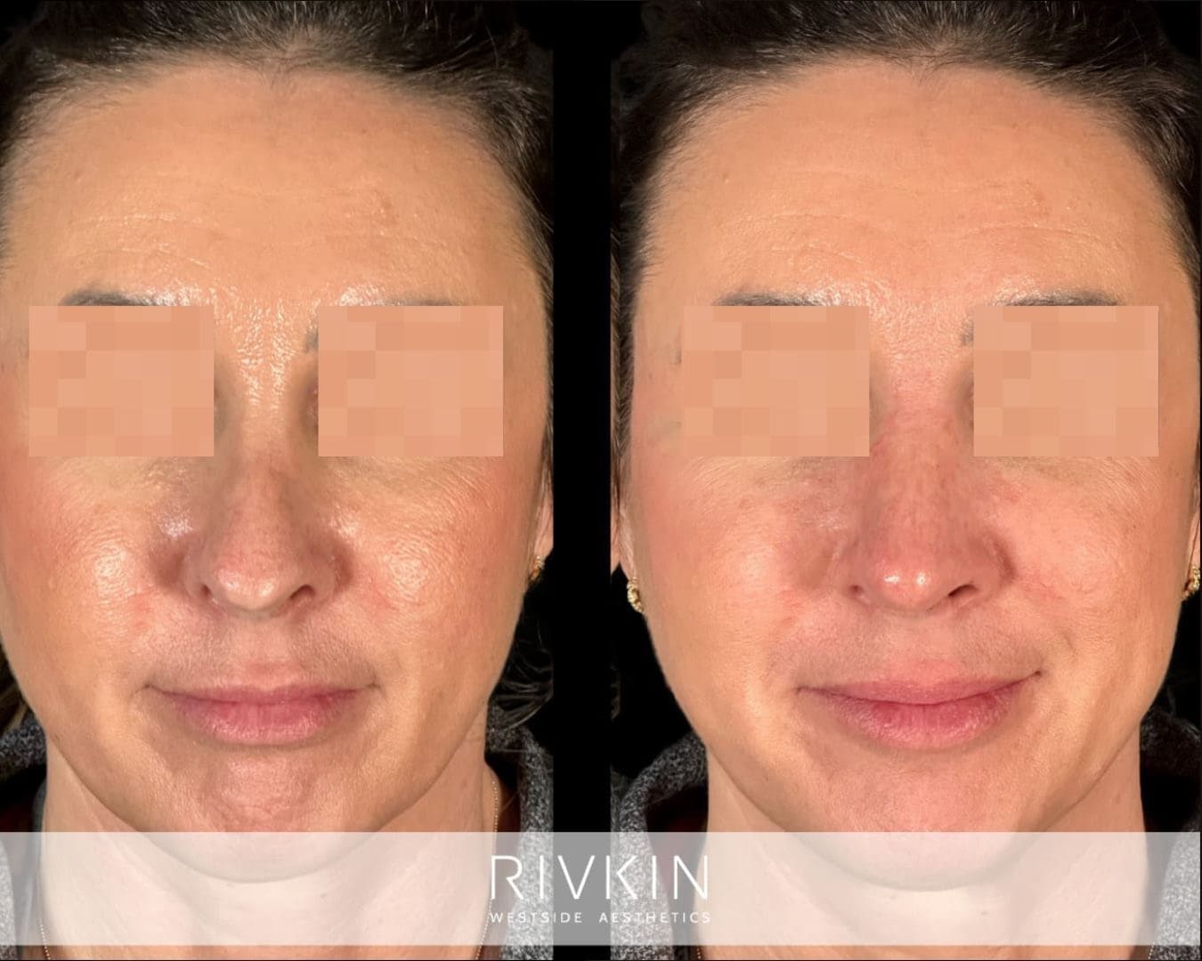 patient before and after revision rhinoplasty