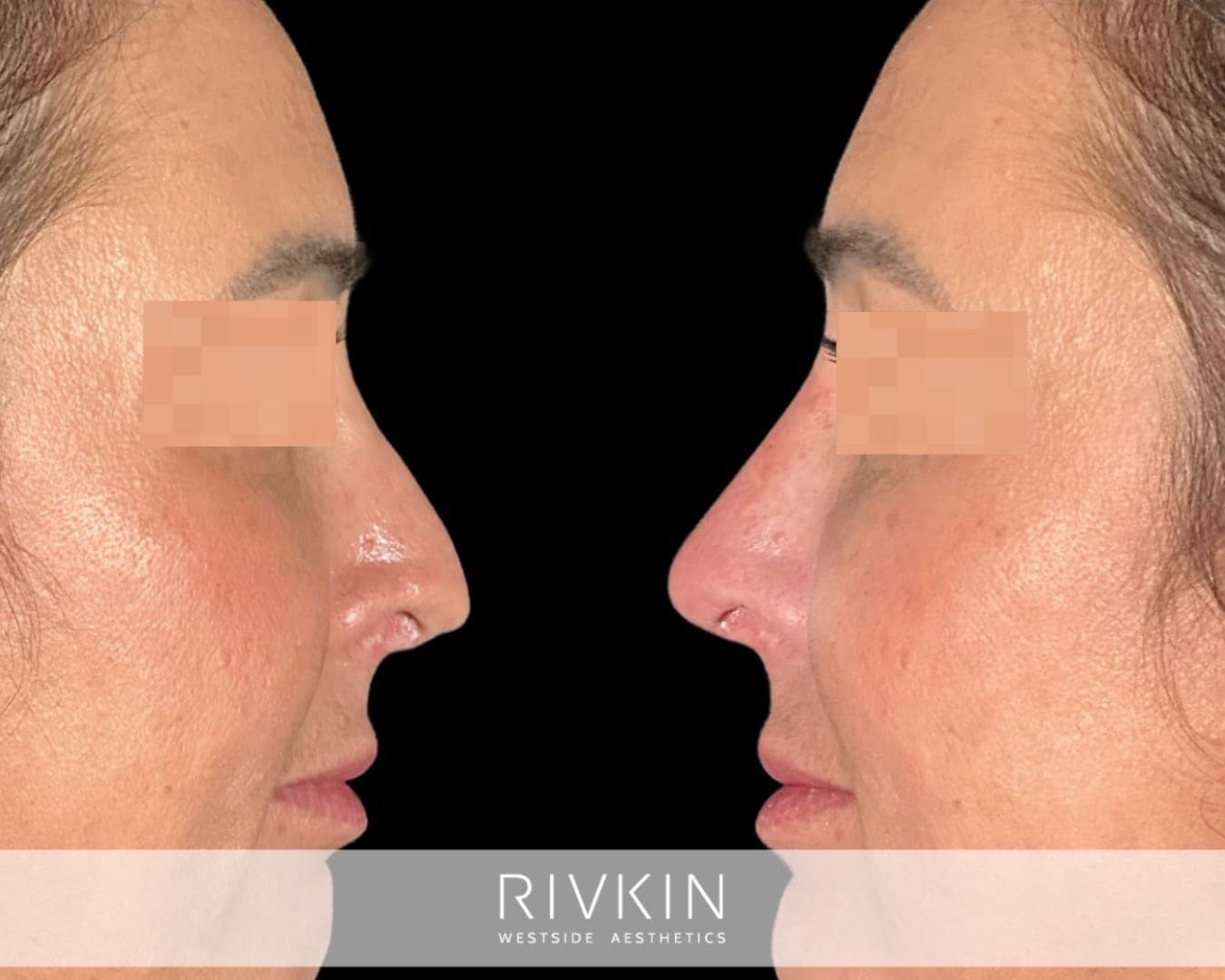 patient before and after revision rhinoplasty