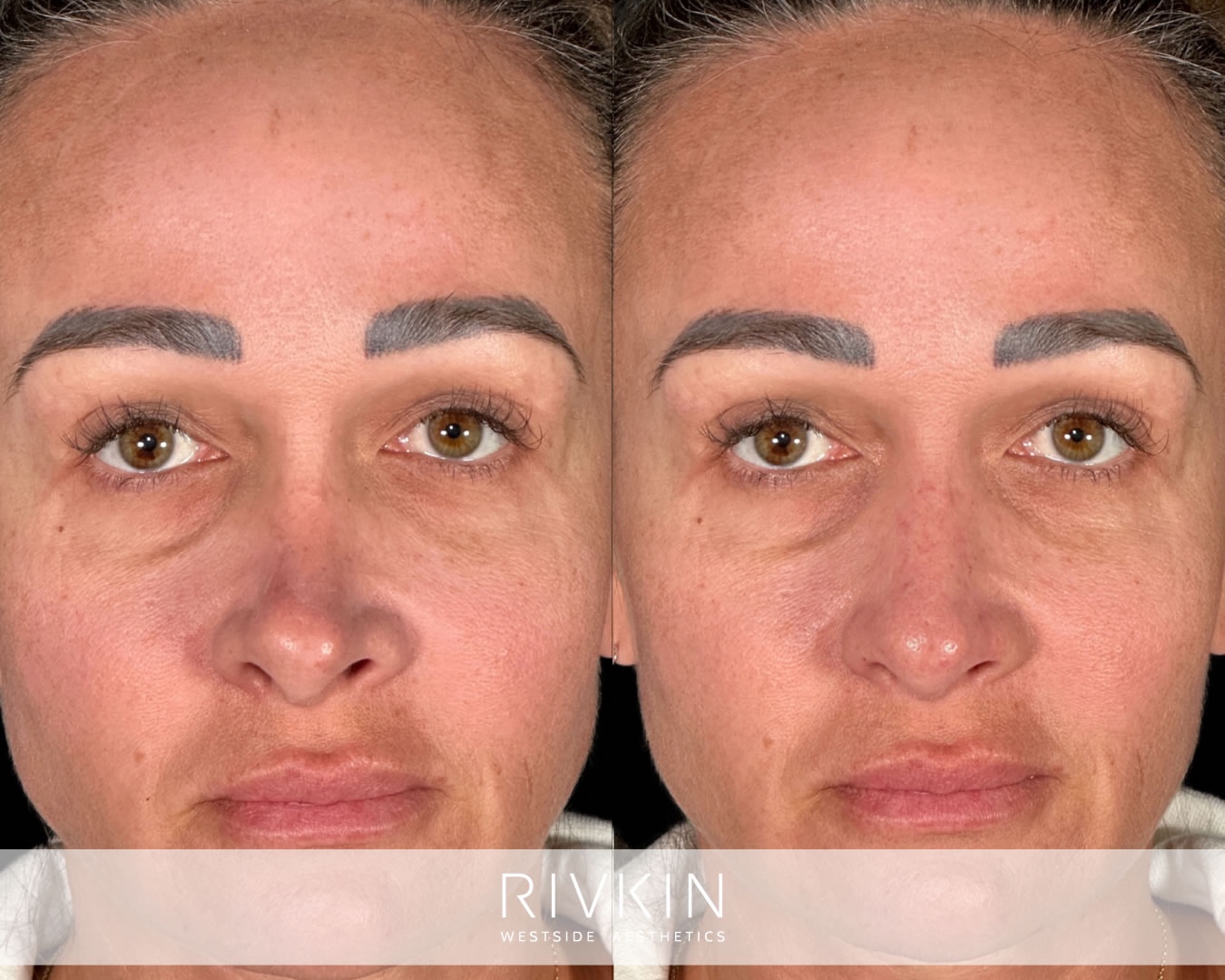 Before non-surgical revision rhinoplasty