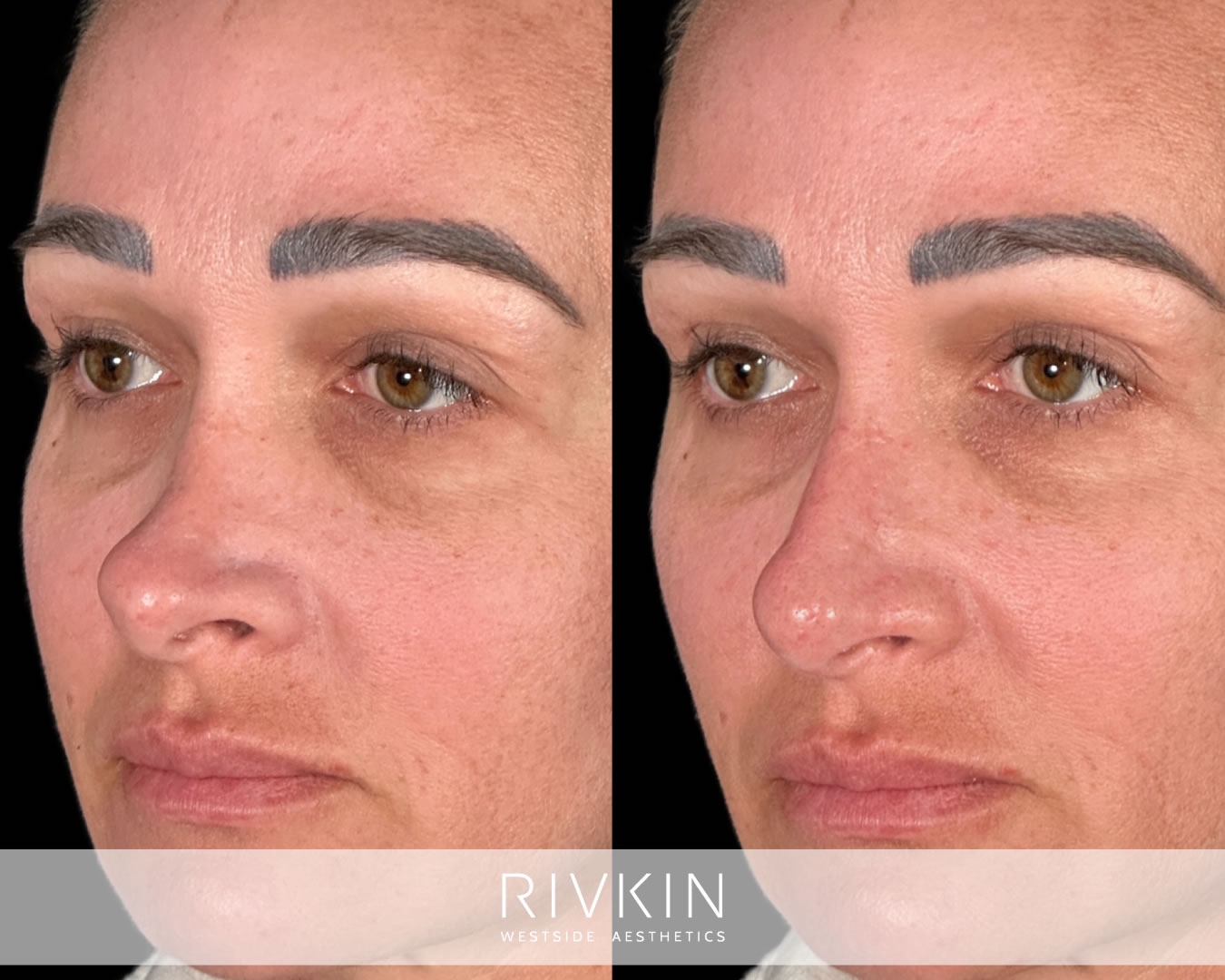 Before non-surgical revision rhinoplasty,