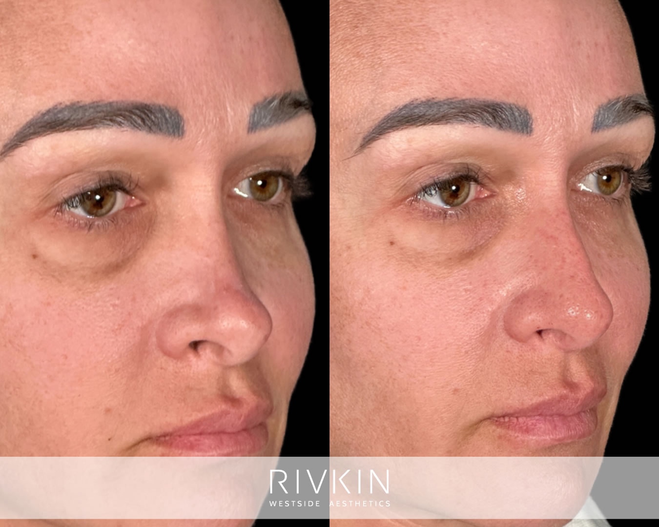 Before non-surgical revision rhinoplasty