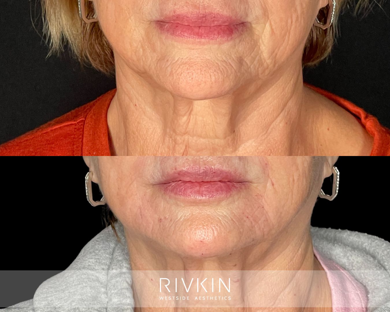 before and after photo of marionette lines removal procedure