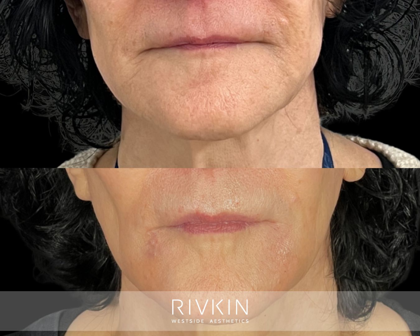 before and after marionette lines treatment