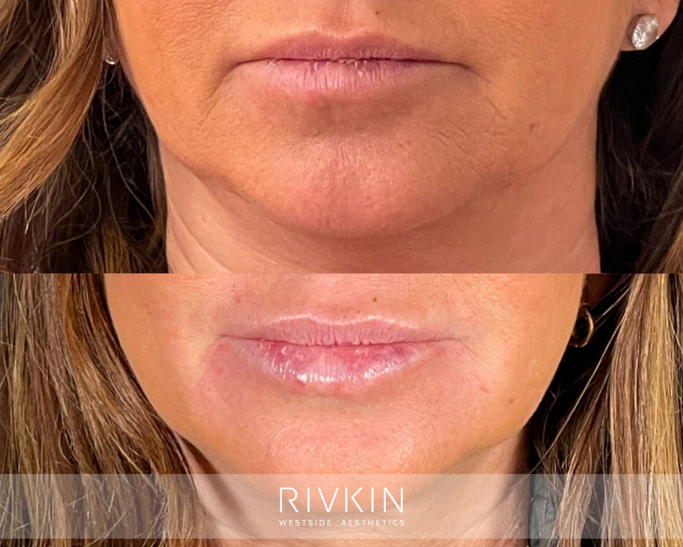before and after marionette lines treatment