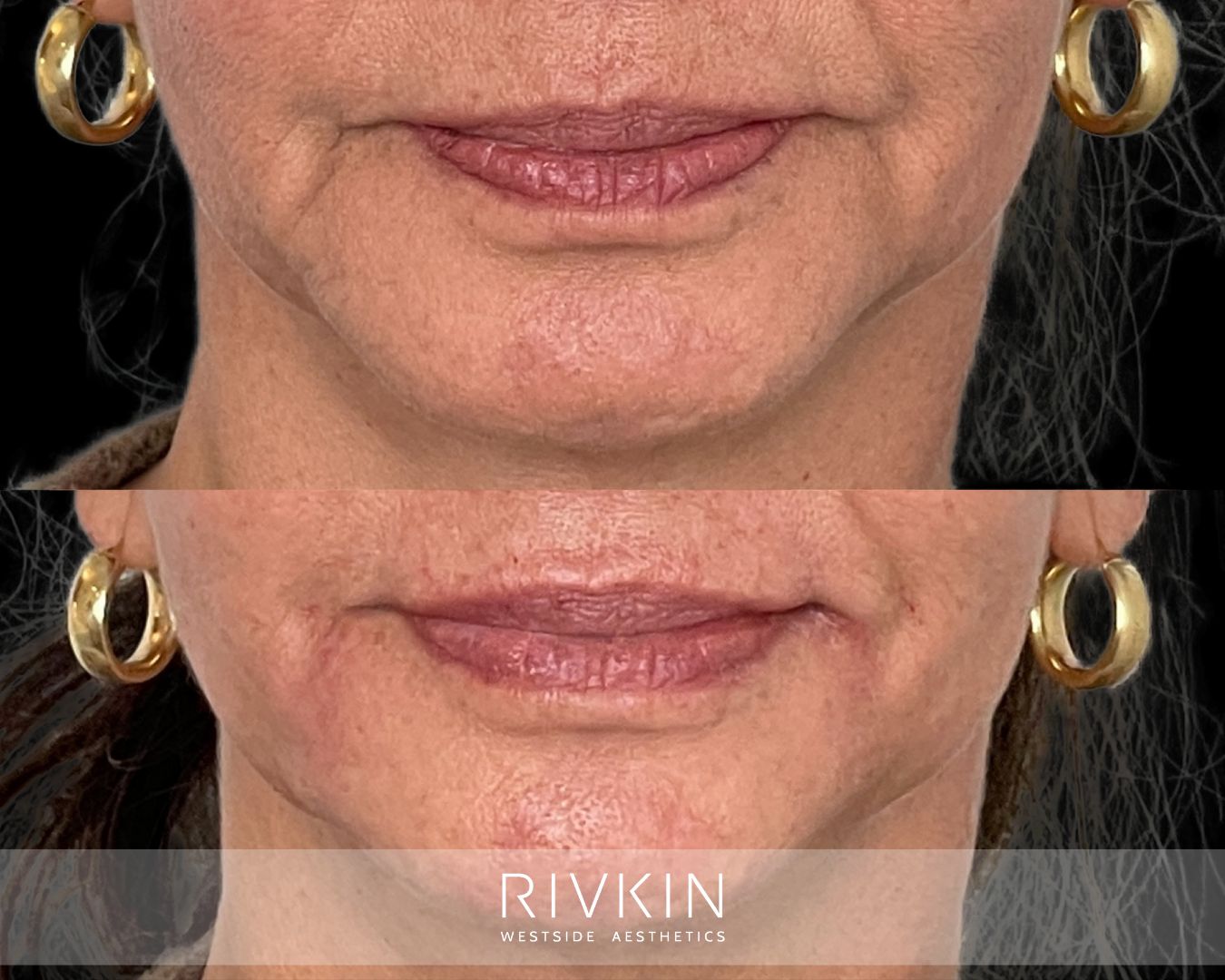 before and after marionette lines treatment