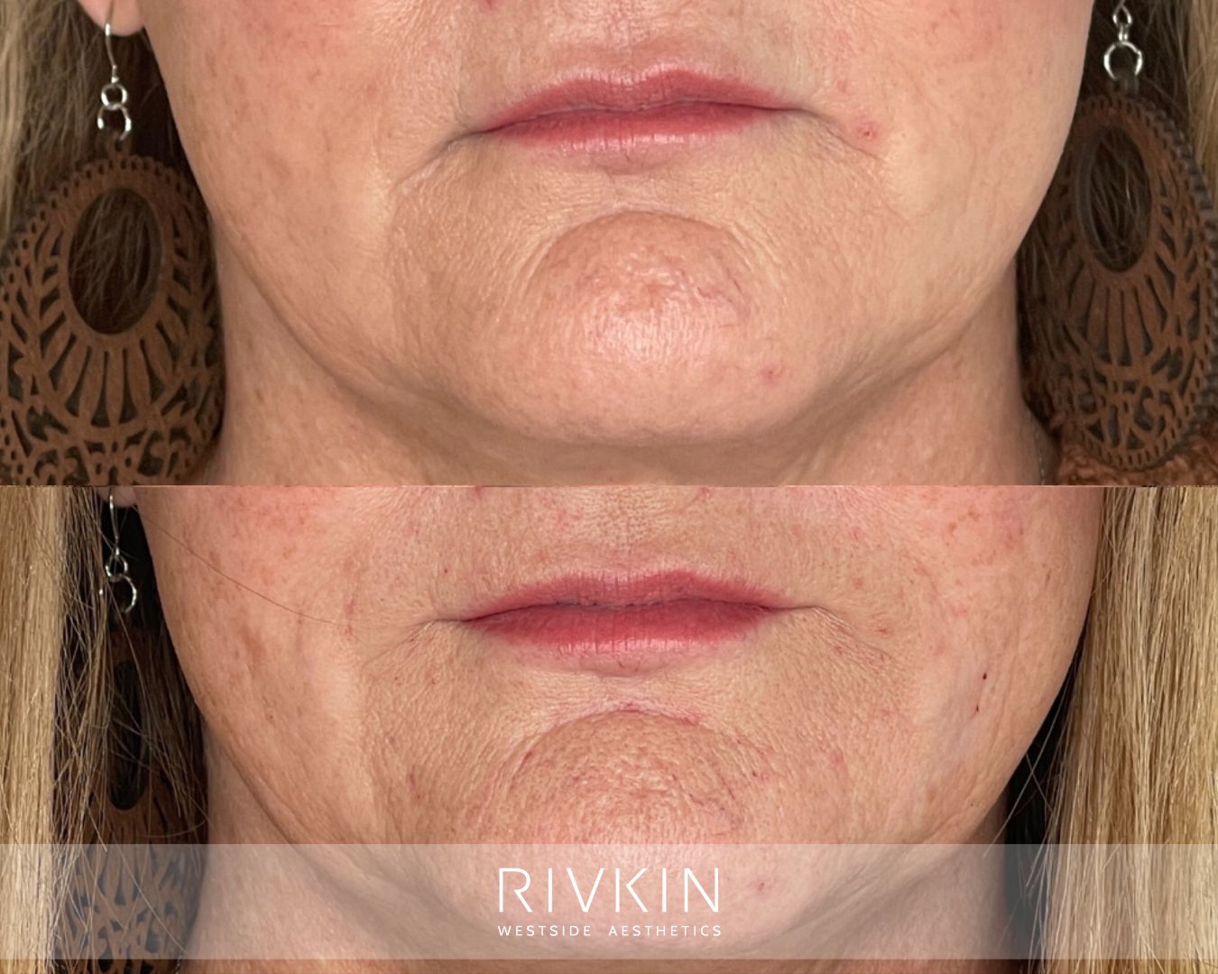 before and after marionette lines treatment