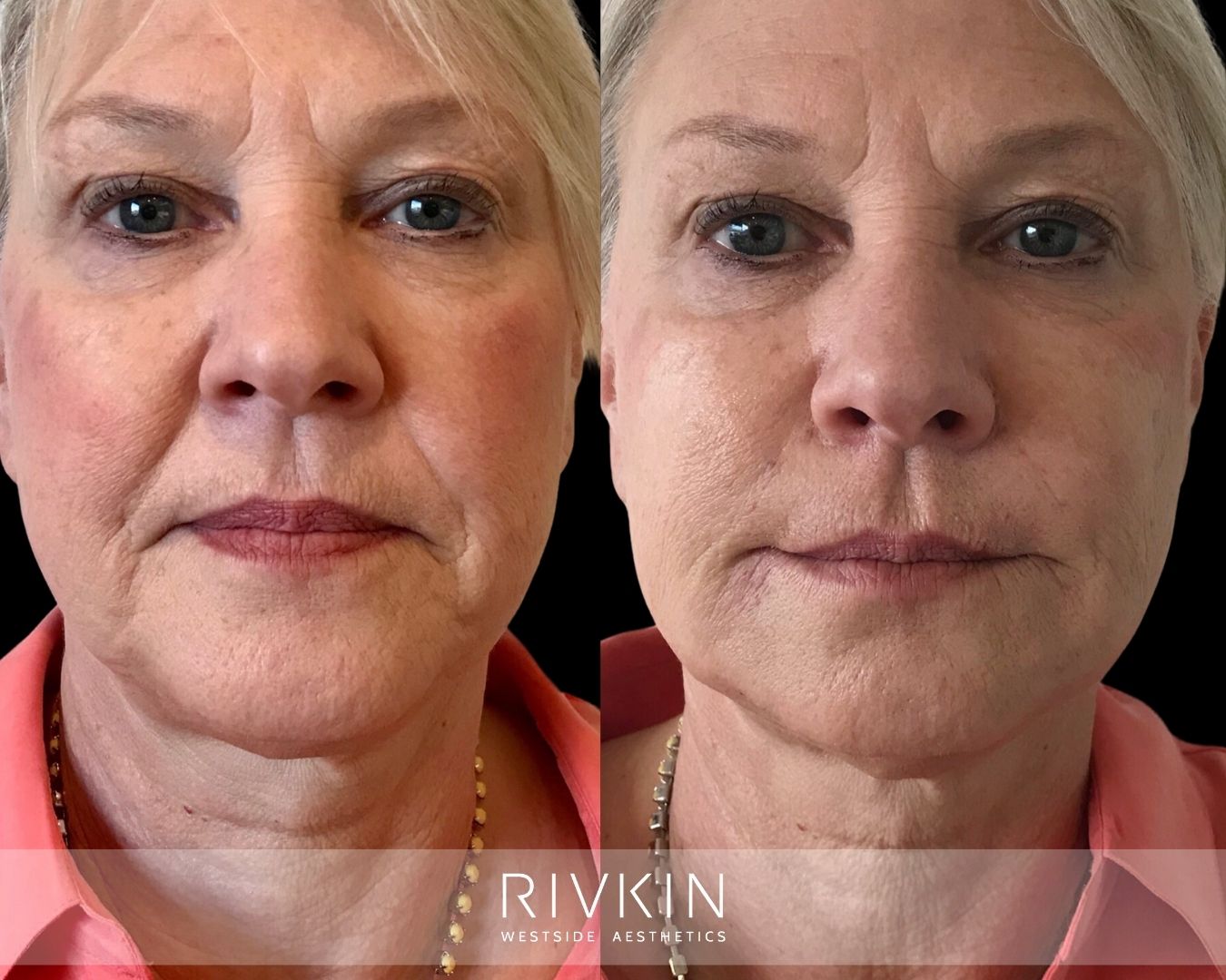 before and after marionette lines treatment