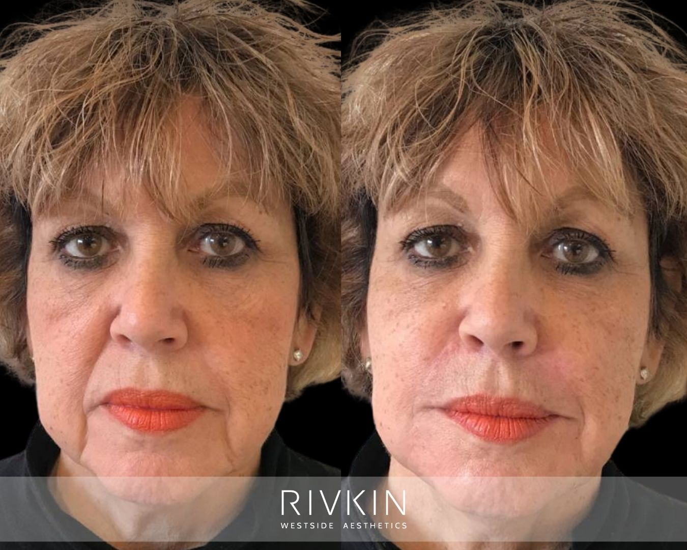 before and after marionette lines treatment