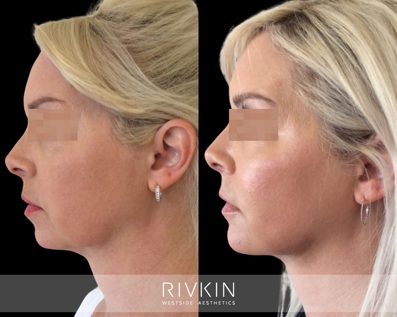 Before and after photo showing lifted and sculpted face with cheek and jawline filler for natural, youthful contour.