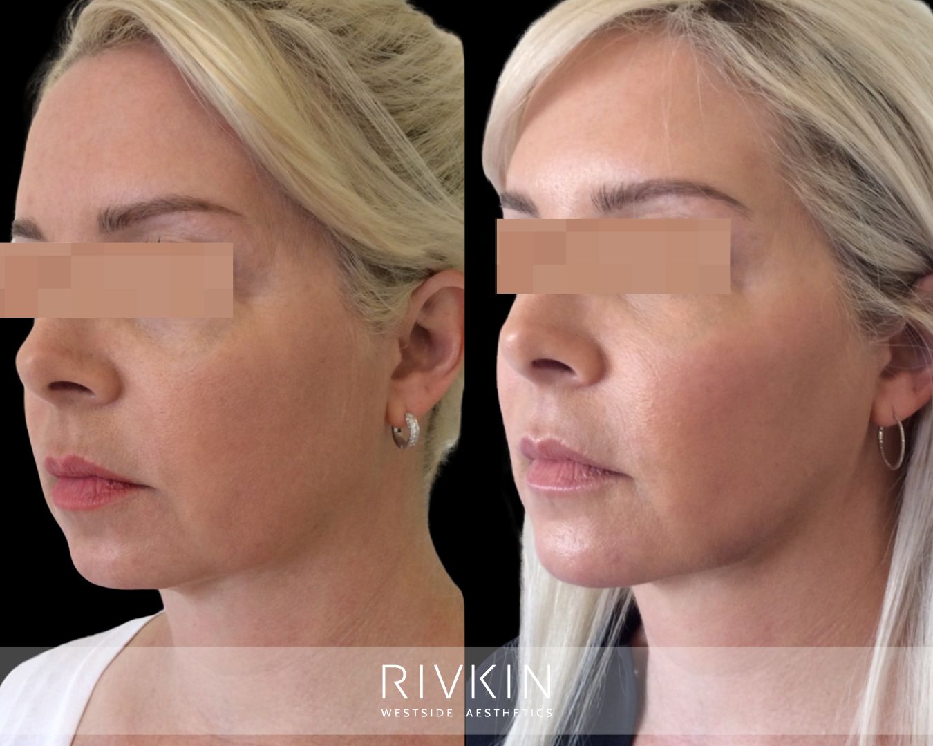 Before and after photo showing lifted and sculpted face with cheek and jawline filler for natural, youthful contour.