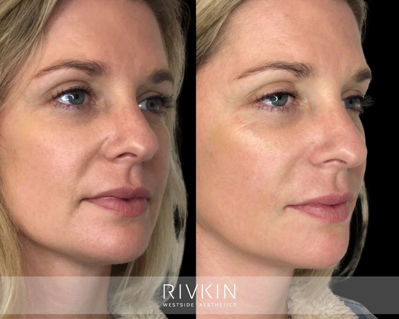 before and after Nasolabial Folds treatment