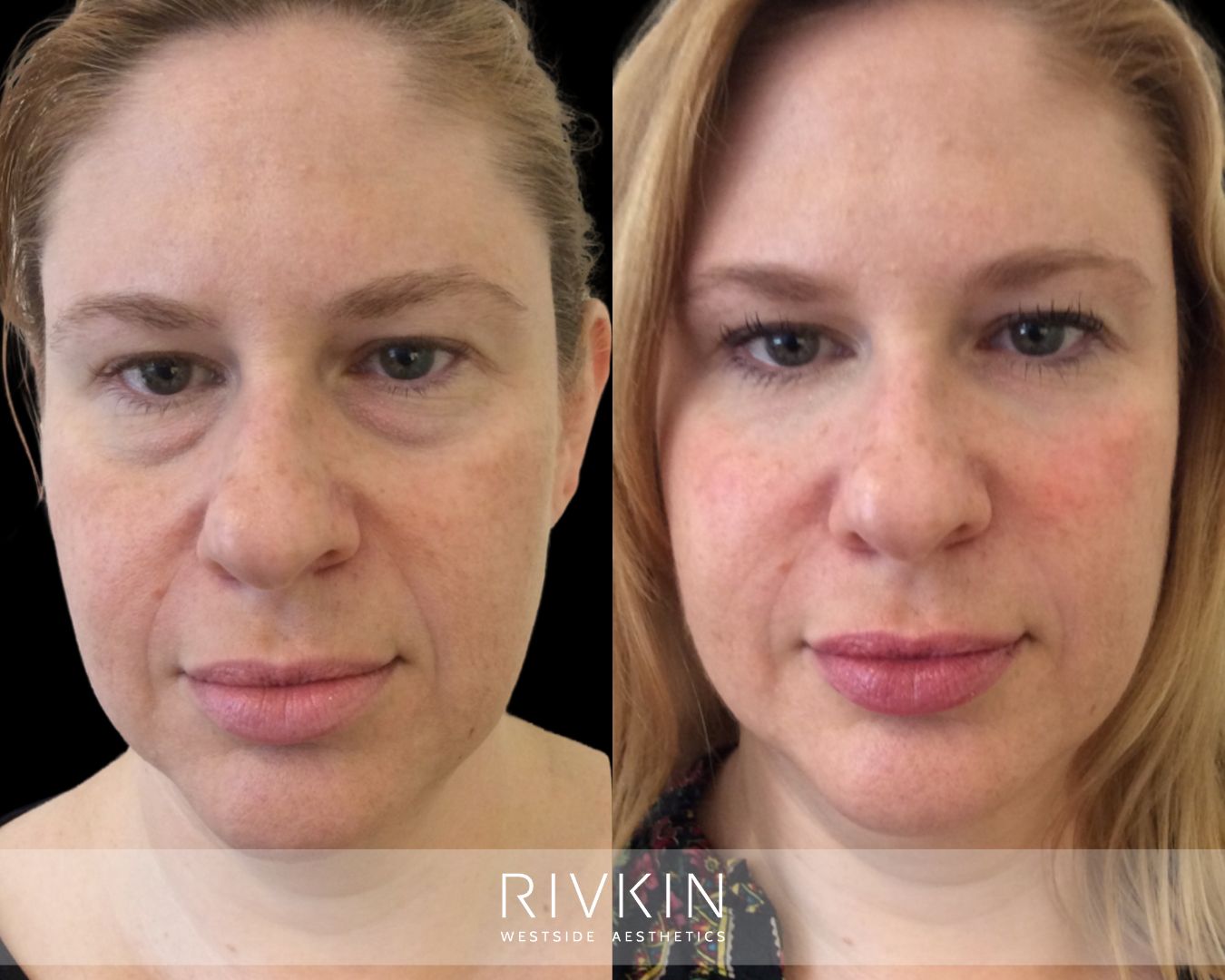 Before and after photo showing fuller cheeks, smoother under eyes, and softened smile lines with facial filler for a refreshed, youthful look.
