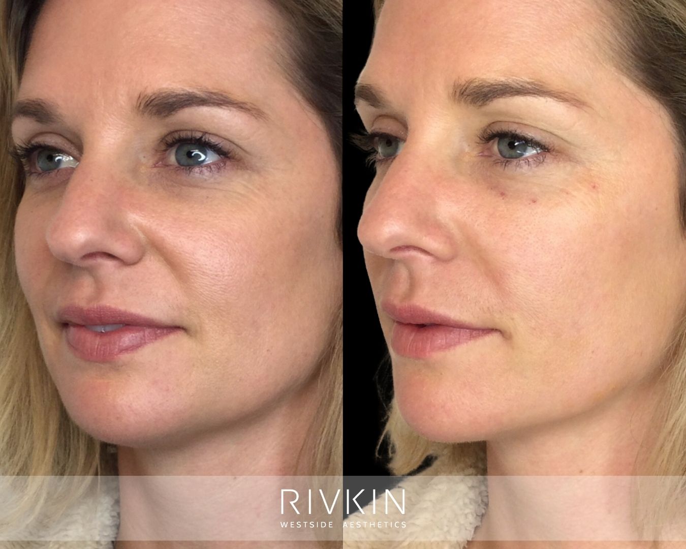 before and after Nasolabial Folds treatment