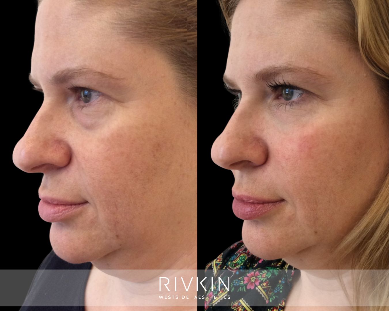 Before and after photo showing fuller cheeks, smoother under eyes, and softened smile lines with facial filler for a refreshed, youthful look.