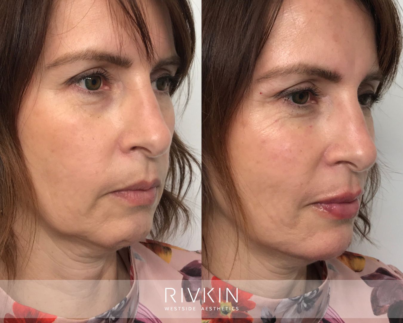 Before and after photo showing natural facial lift and volume restoration with dermal fillers.