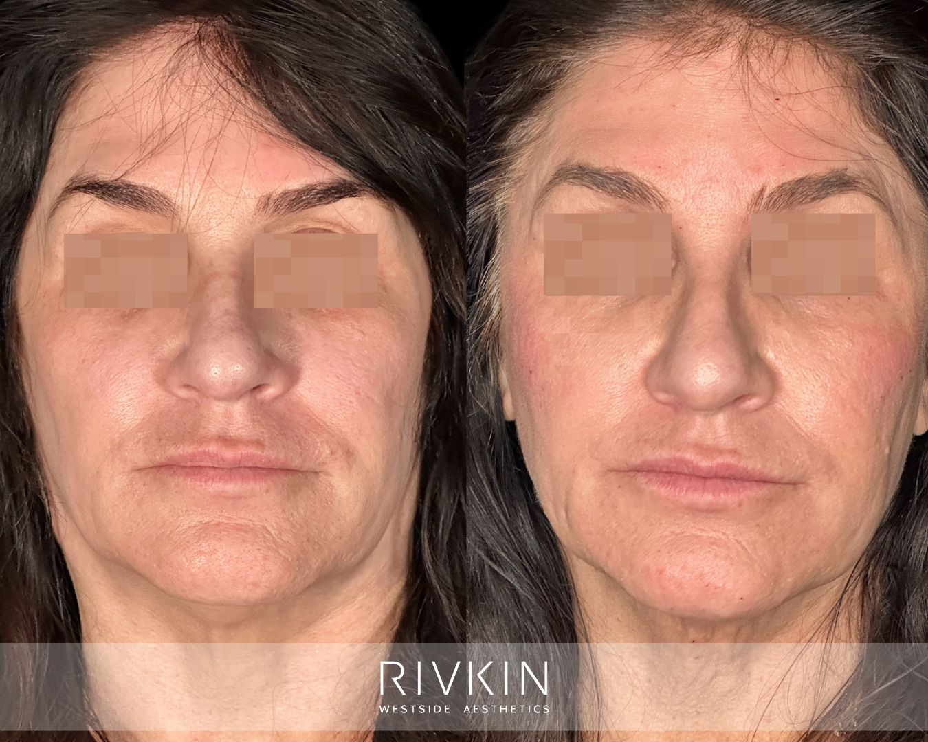 before and after cheeks procedure