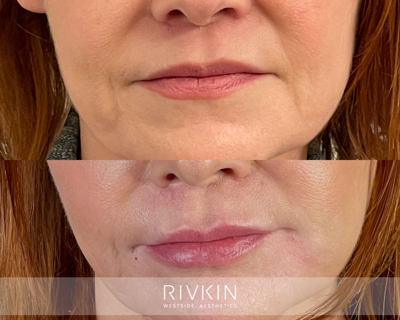 before and after Nasolabial Folds treatment