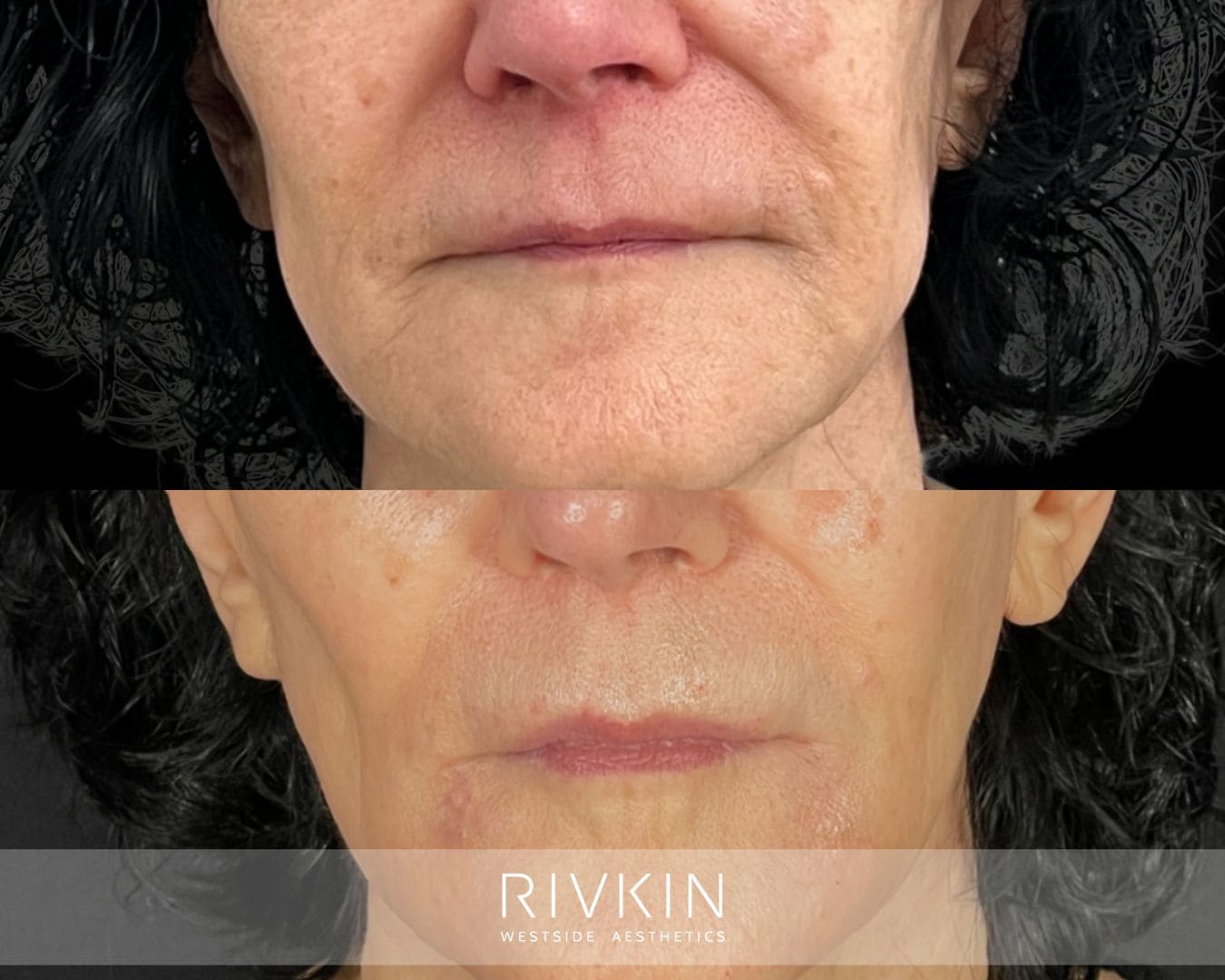 Before and after dermal filler treatment: noticeable improvement of deep nasolabial folds, restoring smoother midface contours and a natural, refreshed look.
