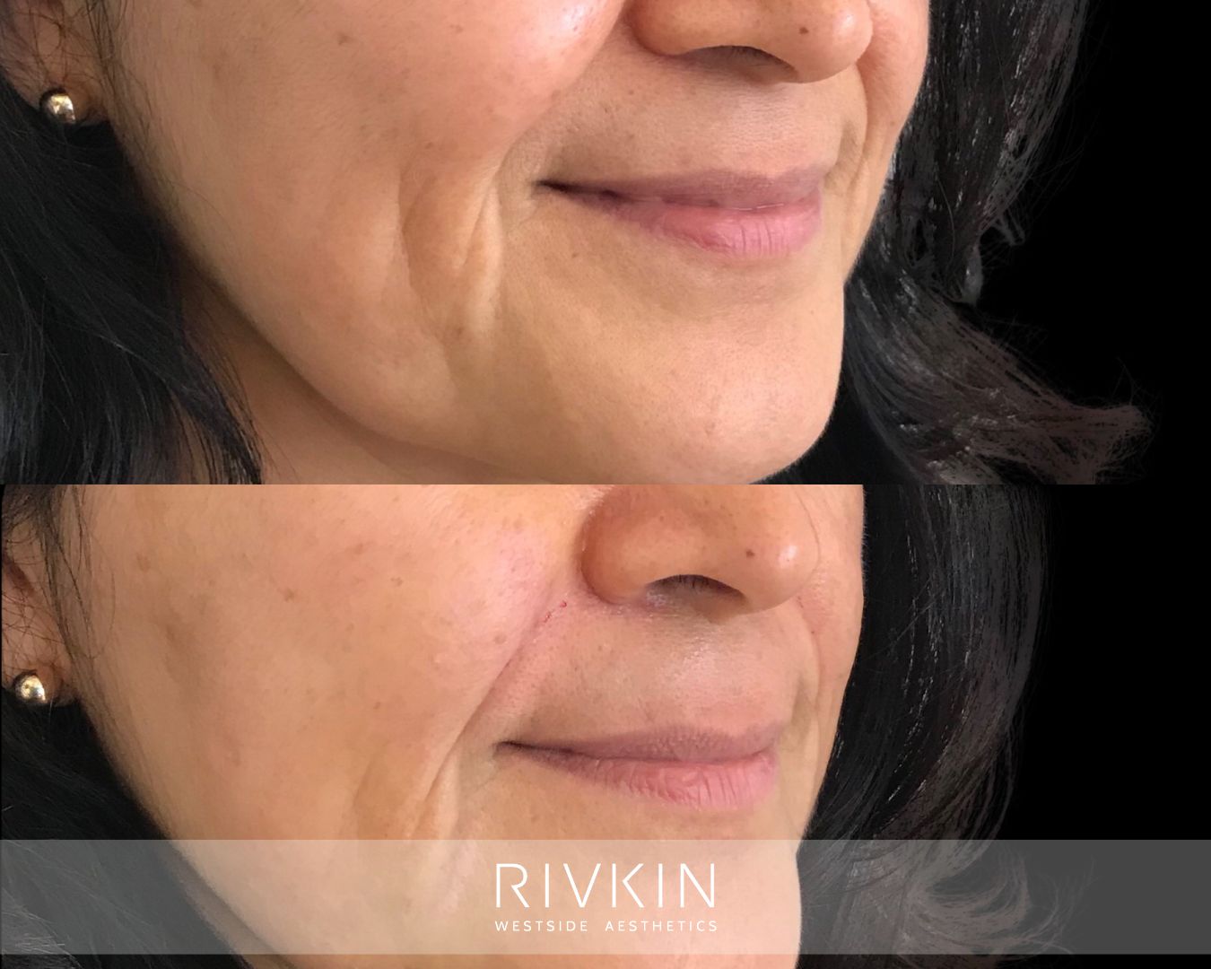 before and after Nasolabial Folds treatment