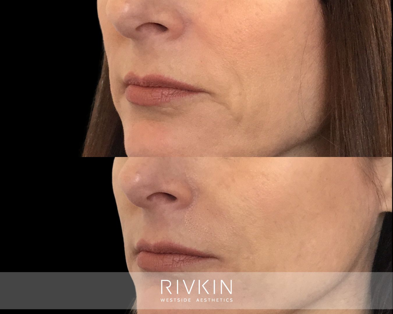 Before and after dermal filler treatment to nasolabial folds: fine smile lines softened with subtle, natural-looking results that preserve expression