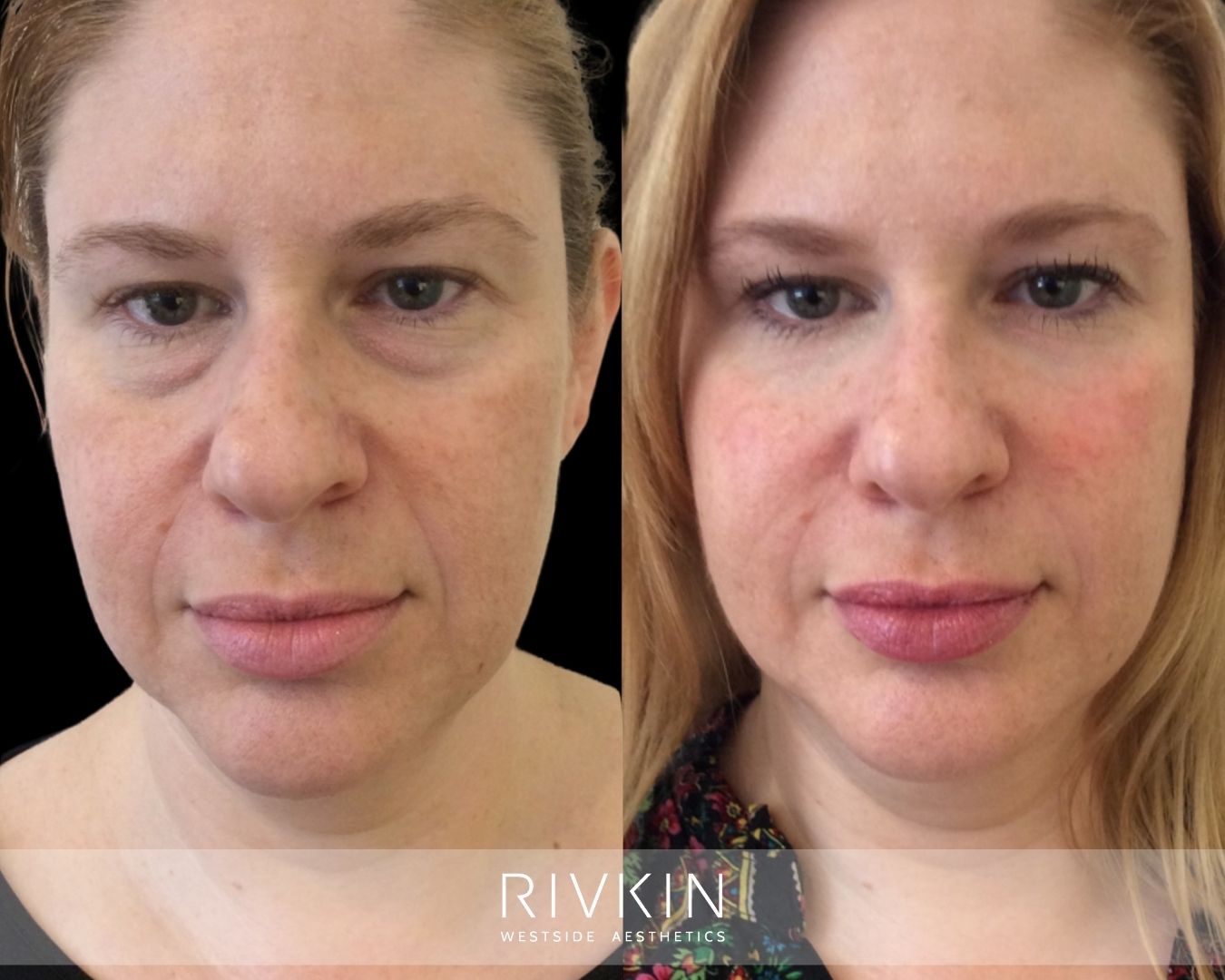 Before and after cheek, under-eye, and nasolabial fold filler: restored midface volume, smoother contours, and a brighter, more refreshed appearance