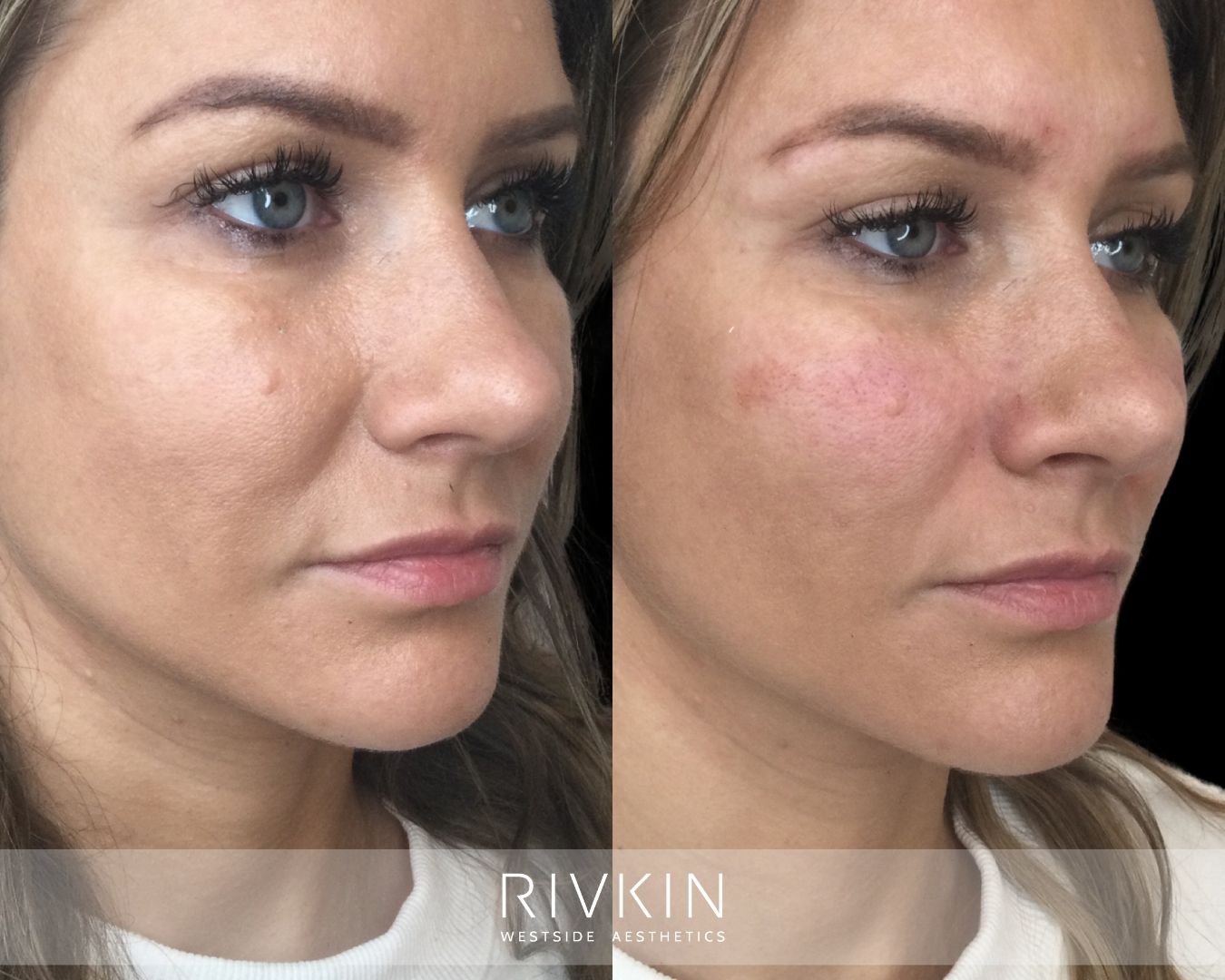Before and after treatment of nasolabial folds with dermal filler: fine smile lines gently smoothed for a refreshed look that preserves natural expression.