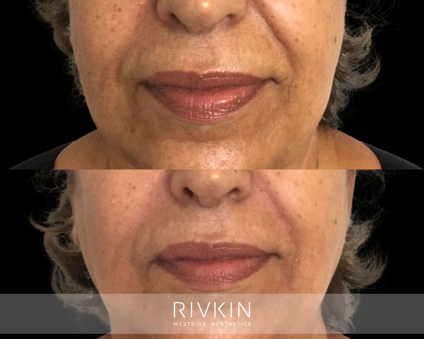Before and after dermal filler treatment to nasolabial folds: restored volume and smoother midface for a lifted, refreshed, and natural-looking result.