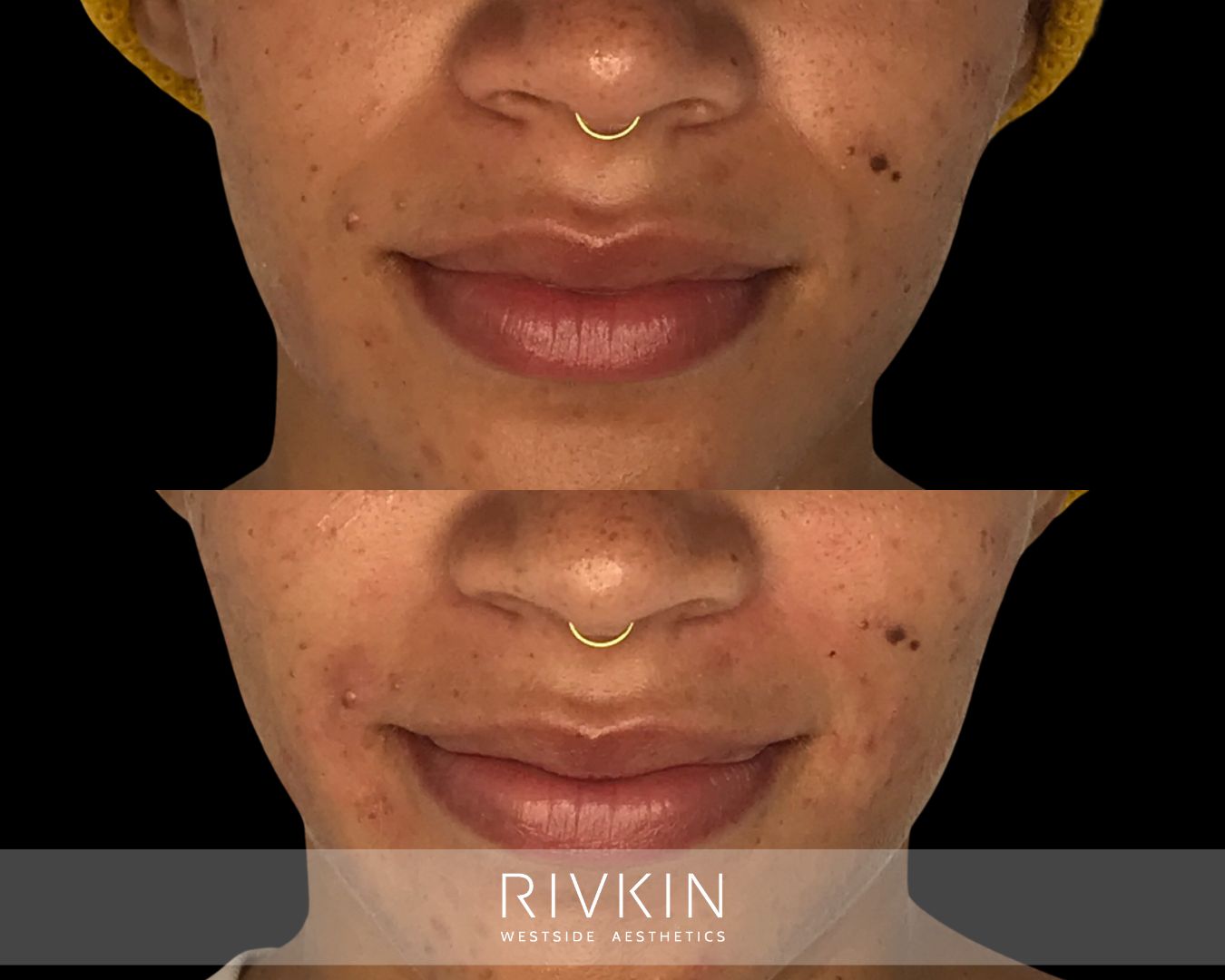 Before and after subtle dermal filler to nasolabial folds in a younger patient: soft correction to maintain natural contours and prevent deepening lines.