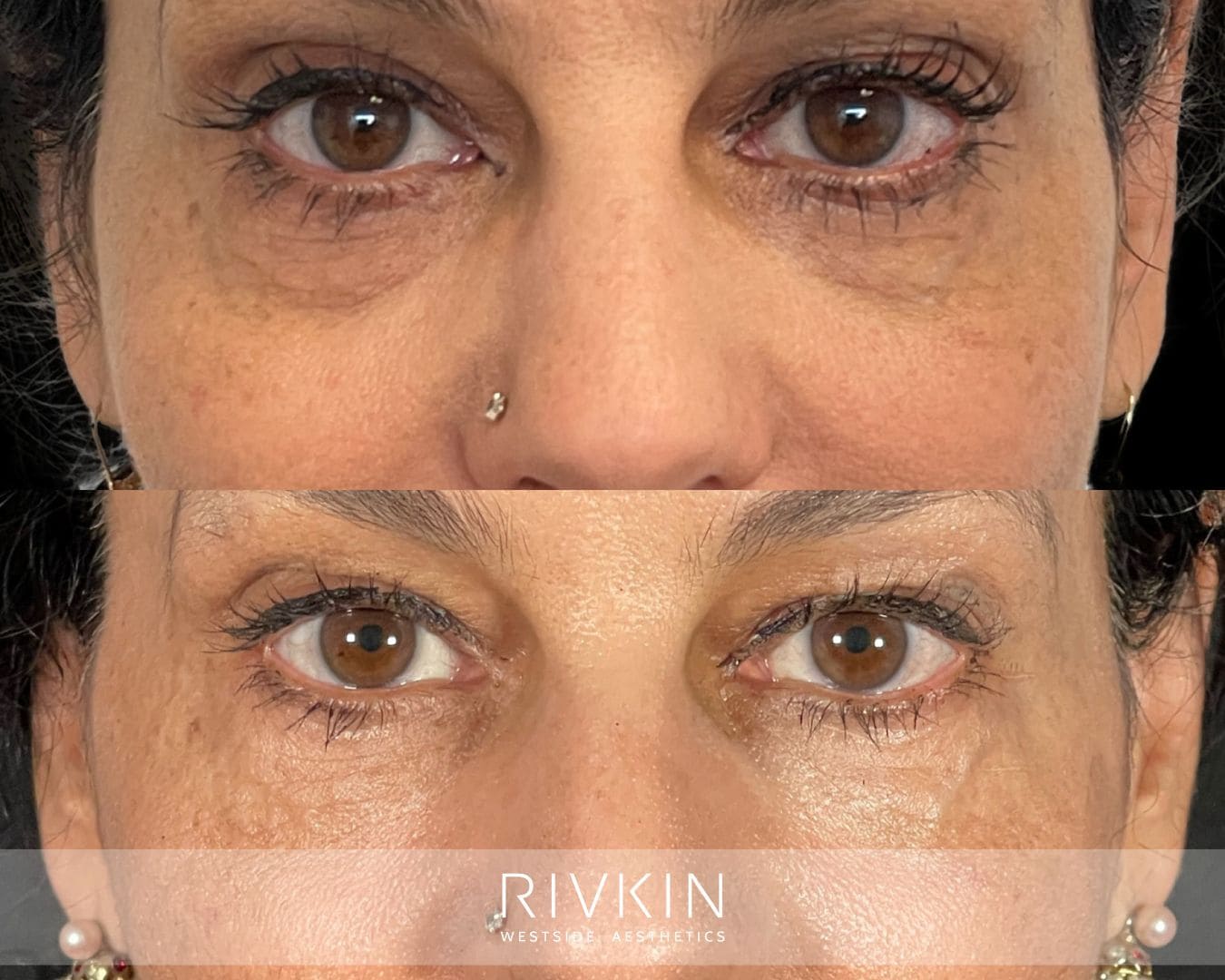 Top: Under-eye area showing hollowness and fine lines, giving a tired appearance. Bottom: Under-eye area appears smoother and brighter with restored volume, reducing shadows for a refreshed, more youthful look.