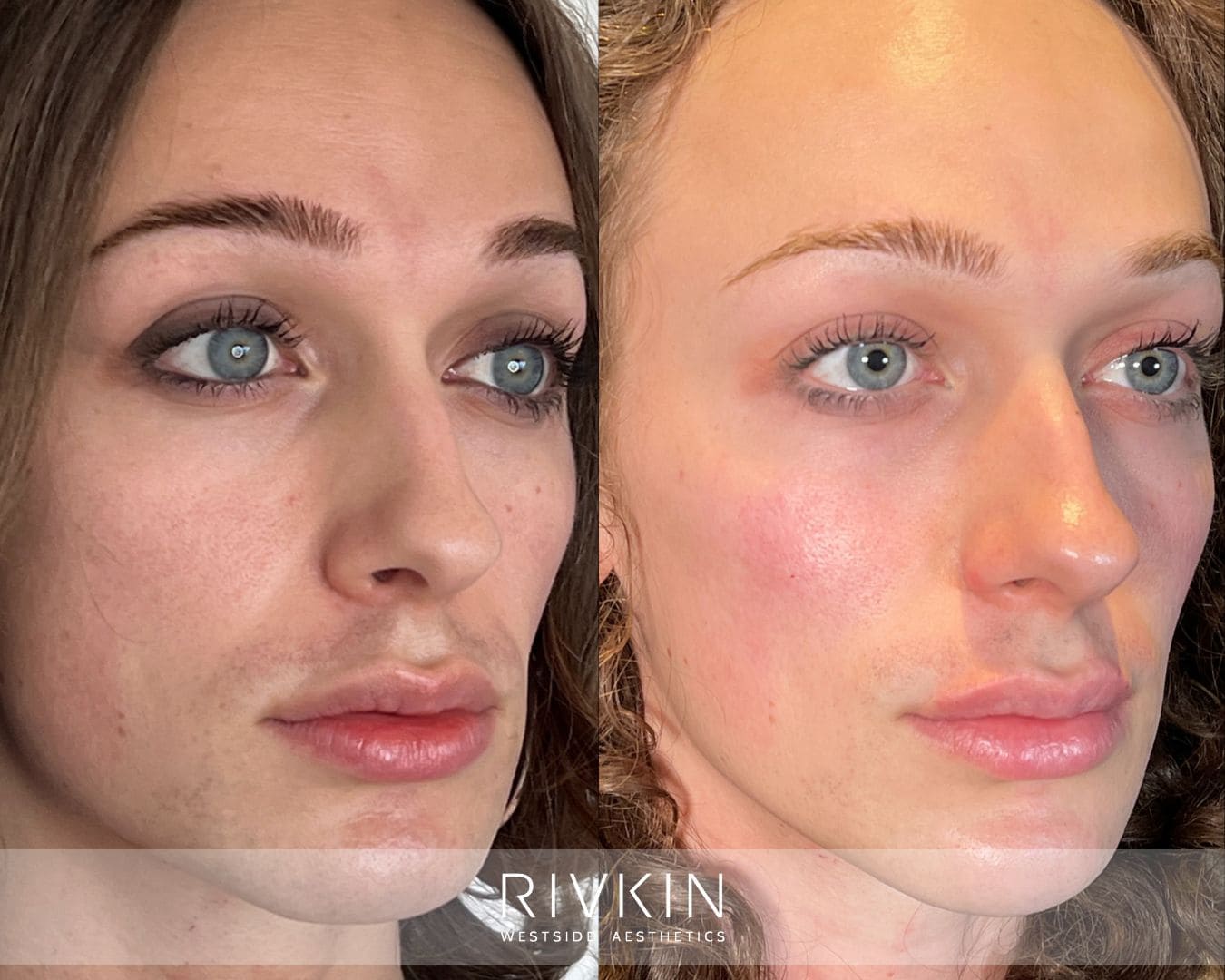 Side-by-side comparison of a face before and after filler treatment. Left: less volume in cheeks and under-eye area. Right: enhanced midface with fuller cheeks and smoother under eyes, creating a softer, more feminine look while preserving natural expression.