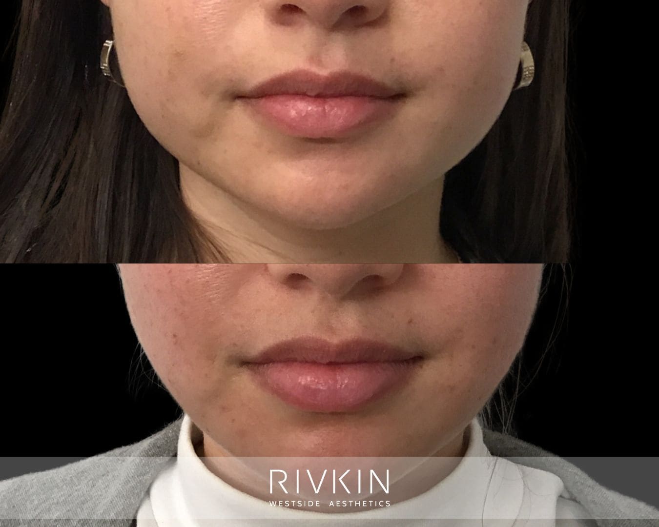 Top: Jawline appears wider with prominent masseter muscles. Bottom: Slimmer, softer jawline after Botox jaw reduction, creating a more contoured lower face.