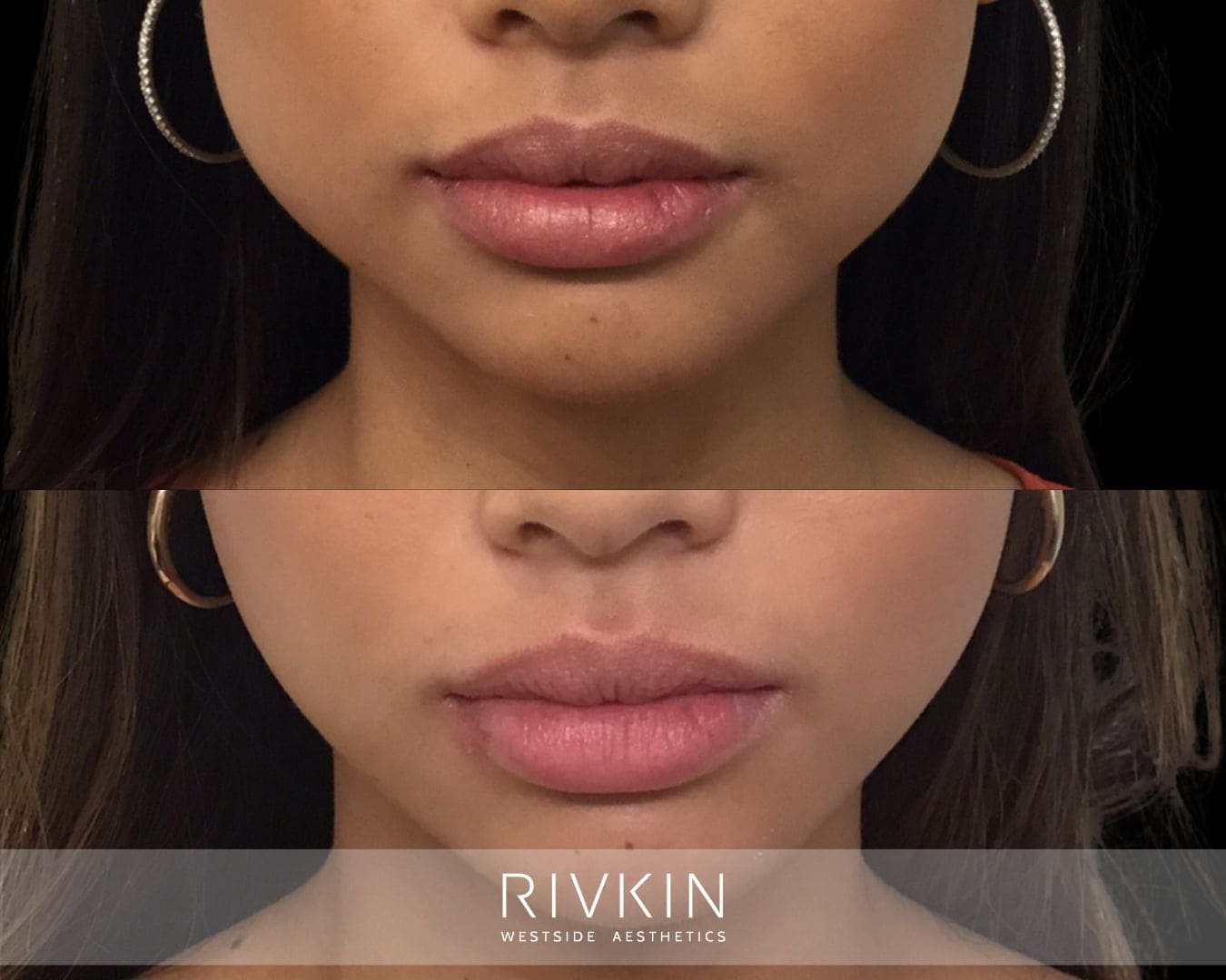 Top: Jawline appears tense and broader due to overactive masseter muscles. Bottom: Softer, more V-shaped jawline after Botox treatment, with reduced tension and a slimmer lower face.