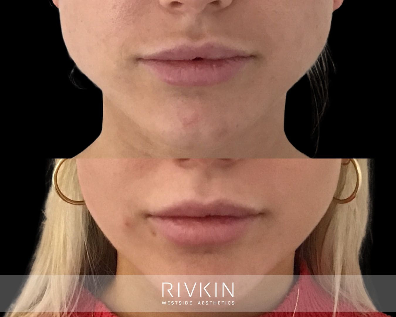 Top: Jawline appears fuller due to enlarged masseter muscles from clenching. Bottom: More contoured, slimmer lower face after Botox treatment, with improved facial balance and reduced jaw tension.