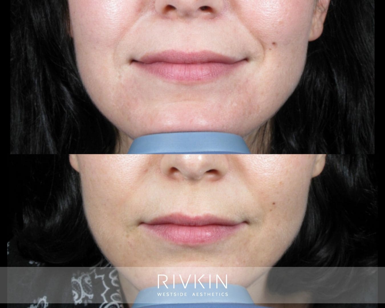 Top: Jaw appears tense and square from overworked masseter muscles. Bottom: Tapered, more sculpted jawline after Botox treatment, with reduced jaw tension and enhanced facial contour.