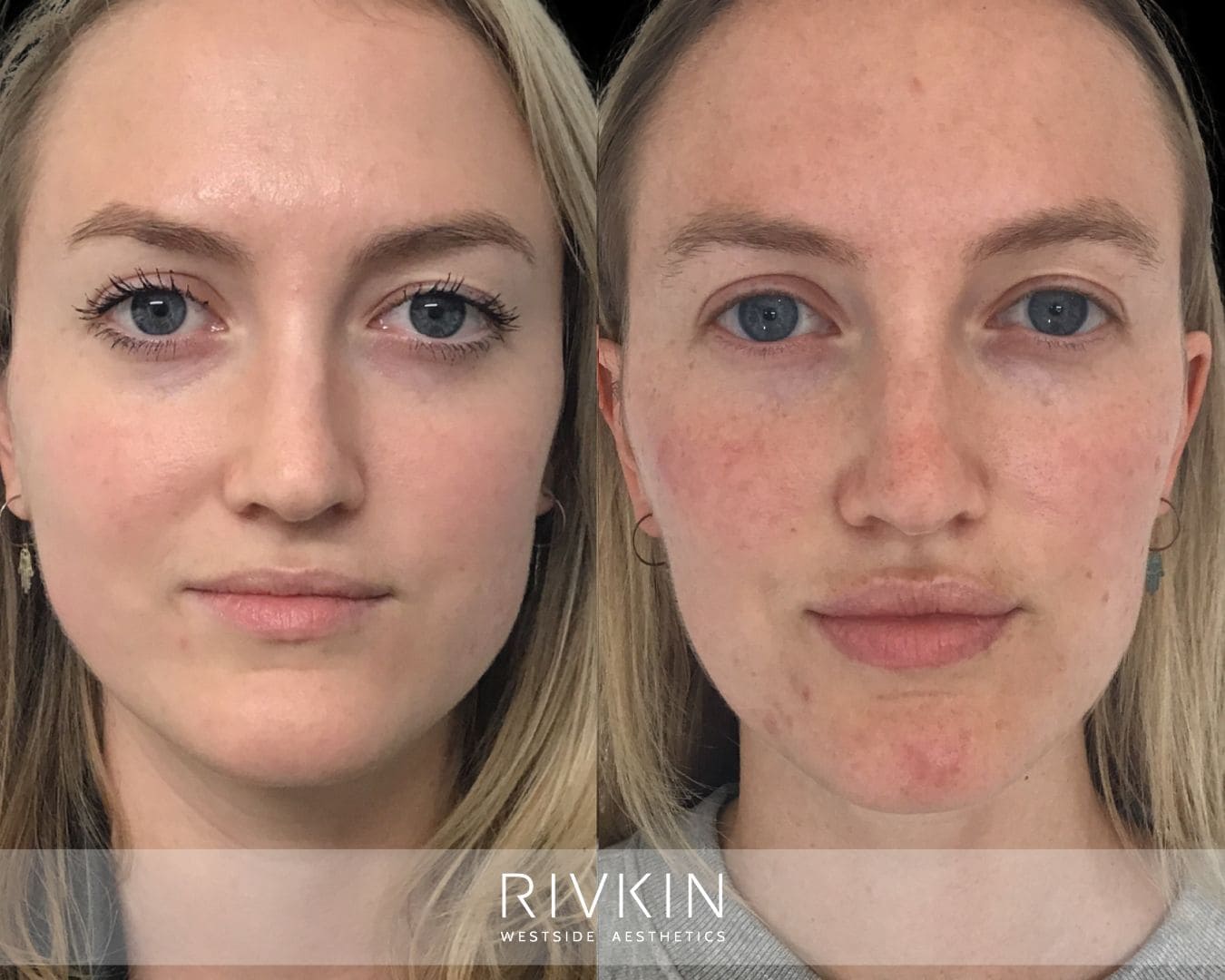 Left: Jawline appears wider and more square from clenching-related muscle enlargement. Right: Slimmer, softer jawline after Botox treatment, with reduced tension and improved facial balance.