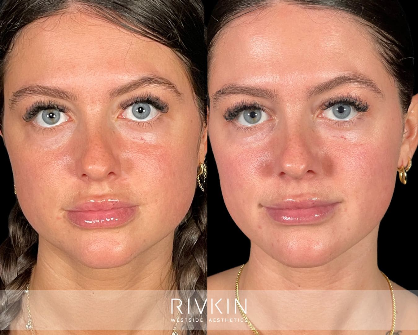 Side-by-side before and after photo showing fuller, tense jawline on the left and softer, more V-shaped jawline with reduced tension on the right after Botox treatment.
