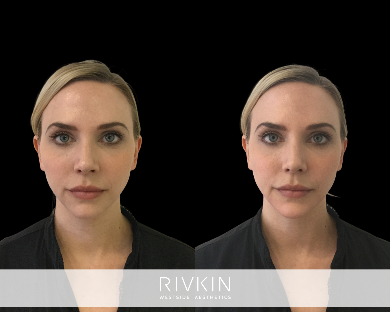 A defined jawline creates a clean line from the chin back to the ear, framing the face and sharpening the profile from every angle.